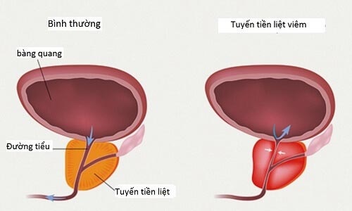 Viêm tuyến tiền liệt là tình trạng sưng viêm ở tuyến tiền liệt