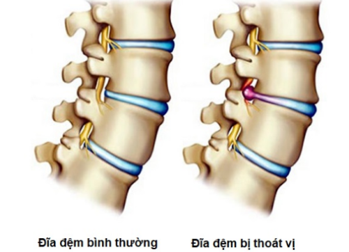 Thoát vị đĩa đệm là tình trạng bất thường khi đĩa đệm bị nghiêng hoặc bị tràn ra ngoài vị trí bình thường